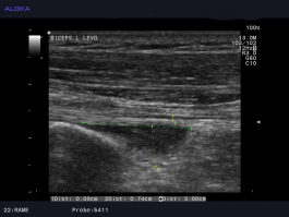 Ultrazvok rame - peritendinitis, levi biceps